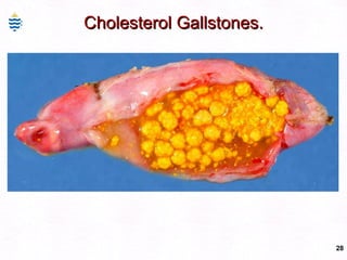 Cholesterol Gallstones. 