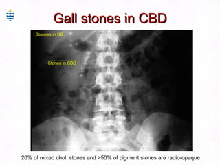 Gall stones in CBD Stones in CBD Stonees in GB 20% of mixed chol. stones and >50% of pigment stones are radio-opaque 