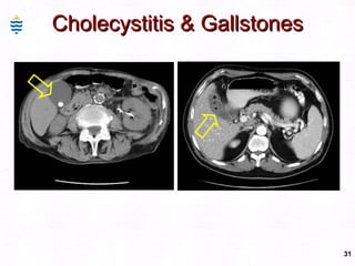 Cholecystitis & Gallstones 