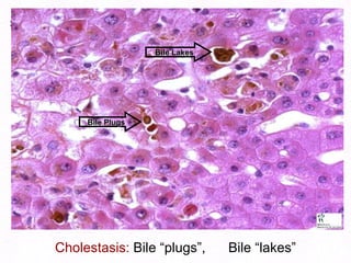 Cholestasis:  Bile “plugs”,  Bile “lakes” Bile Plugs Bile Lakes 