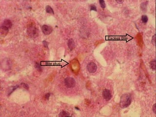 Excess Bile Bile plug 