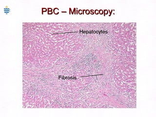 PBC – Microscopy: 