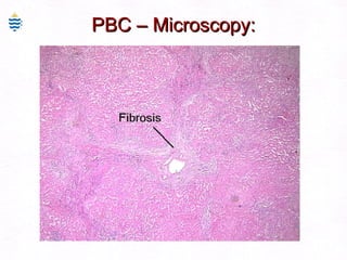 PBC – Microscopy: 