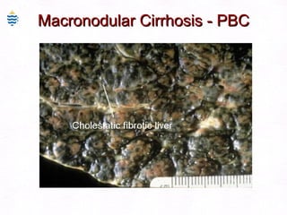 Macronodular Cirrhosis - PBC 