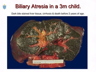 Biliary Atresia in a 3m child. Dark bile stained liver tissue, cirrhosis & death before 2 years of age. 