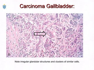 Carcinoma Gallbladder: Note irregular glandular structures and clusters of similar cells. 