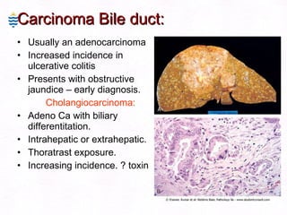 Carcinoma Bile duct: Usually an adenocarcinoma  Increased incidence in ulcerative colitis  Presents with obstructive jaundice – early diagnosis. Cholangiocarcinoma: Adeno Ca with biliary differentitation. Intrahepatic or extrahepatic. Thoratrast exposure. Increasing incidence. ? toxin 