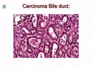 Carcinoma Bile duct: 