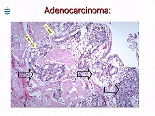 Adenocarcinoma: Normal Adeno Ca 