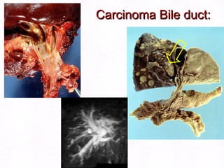 Carcinoma Bile duct: 