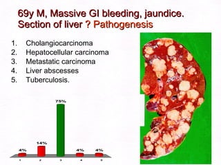 69y M, Massive GI bleeding, jaundice.  Section of liver  ? Pathogenesis Cholangiocarcinoma Hepatocellular carcinoma Metastatic carcinoma Liver abscesses Tuberculosis. 