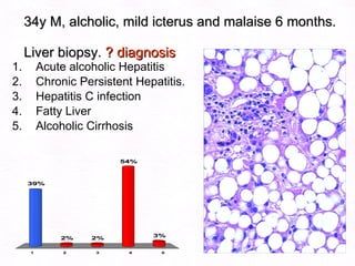 34y M, alcholic, mild icterus and malaise 6 months.  Liver biopsy.  ? diagnosis Acute alcoholic Hepatitis Chronic Persistent Hepatitis. Hepatitis C infection Fatty Liver Alcoholic Cirrhosis   