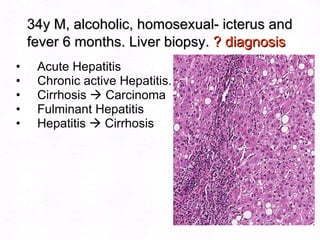 34y M, alcoholic, homosexual- icterus and fever 6 months. Liver biopsy.  ? diagnosis Acute Hepatitis Chronic active Hepatitis. Cirrhosis    Carcinoma Fulminant Hepatitis Hepatitis    Cirrhosis   