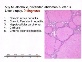 58y M, alcoholic, distended abdomen & icterus. Liver biopsy.  ? diagnosis Chronic active hepatitis. Chronic Persistant hepatitis. Hepatocellular carcinoma. Cirrhosis Chronic alcoholic hepatitis. 