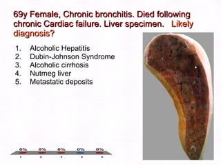 69y Female, Chronic bronchitis. Died following chronic Cardiac failure. Liver specimen.  Likely diagnosis? Alcoholic Hepatitis  Dubin-Johnson Syndrome Alcoholic cirrhosis Nutmeg liver Metastatic deposits 
