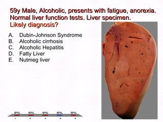 59y Male, Alcoholic, presents with fatigue, anorexia. Normal liver function tests. Liver specimen.  Likely diagnosis? Dubin-Johnson Syndrome Alcoholic cirrhosis Alcoholic Hepatitis Fatty Liver Nutmeg liver 