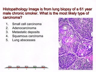 Histopathology Image is from lung biopsy of a 61 year male chronic smoker. What is the most likely type of carcinoma? Small cell carcinoma Adenocarcinoma Metastatic deposits Squamous carcinoma Lung abscesses  