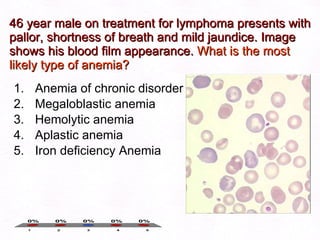 46 year male on treatment for lymphoma presents with pallor, shortness of breath and mild jaundice. Image shows his blood film appearance.  What is the most likely type of anemia? Anemia of chronic disorder Megaloblastic anemia Hemolytic anemia Aplastic anemia Iron deficiency Anemia  