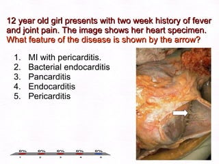 12 year old girl presents with two week history of fever and joint pain. The image shows her heart specimen.  What feature of the disease is shown by the arrow? MI with pericarditis. Bacterial endocarditis Pancarditis Endocarditis Pericarditis 