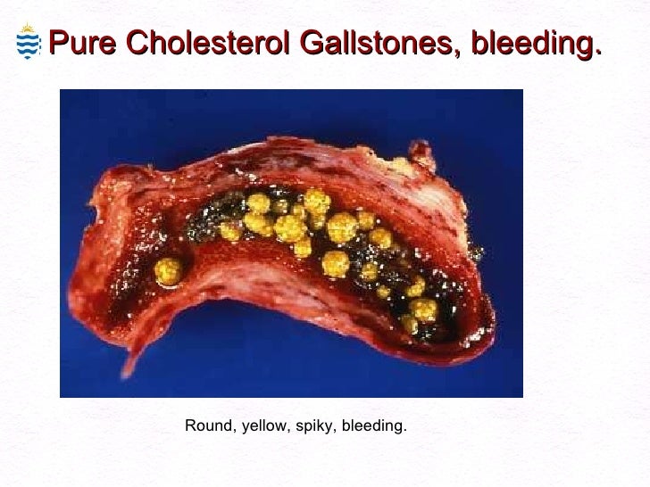 Disorders of Biliary System