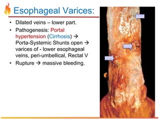 Varices Pathogenesis Pathology of Upper GIT | PPTX