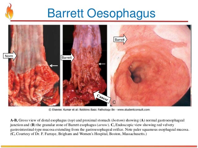 Barrett S Oesophagus Diets