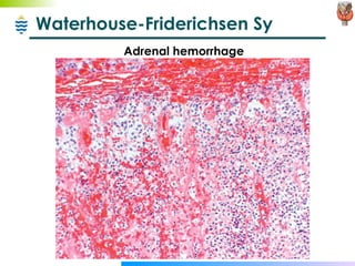 Waterhouse-Friderichsen Sy Adrenal hemorrhage 
