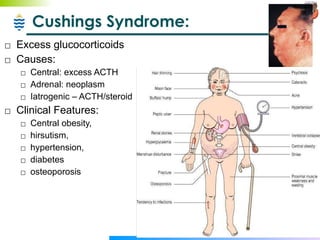 Cushings Syndrome: Excess glucocorticoids  Causes: Central: excess ACTH  Adrenal: neoplasm Iatrogenic – ACTH/steroid  Clinical Features: Central obesity,  hirsutism,  hypertension,  diabetes  osteoporosis  
