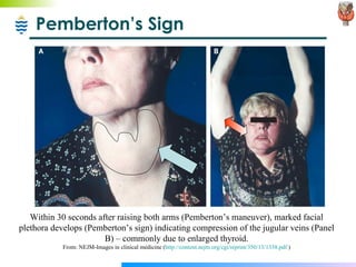 Pemberton’s Sign Within 30 seconds after raising both arms (Pemberton’s maneuver), marked facial plethora develops (Pemberton’s sign) indicating compression of the jugular veins (Panel B) – commonly due to enlarged thyroid. From: NEJM-Images in clinical medicine ( http://content.nejm.org/cgi/reprint/350/13/1338.pdf  ) 