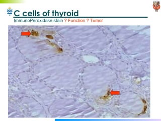 C cells of thyroid  ImmunoPeroxidase stain  ? Function ? Tumor 
