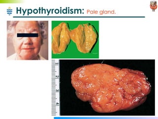Hypothyroidism:  Pale gland. 