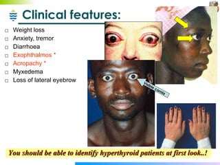 Clinical features: Weight loss Anxiety, tremor Diarrhoea Exophthalmos * Acropachy * Myxedema Loss of lateral eyebrow You should be able to identify hyperthyroid patients at first look..!  Visible cornia 