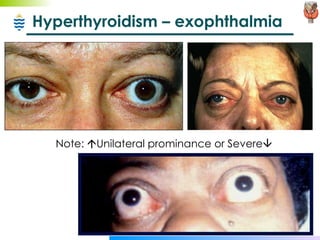 Hyperthyroidism – exophthalmia Note:   Unilateral prominance or Severe    