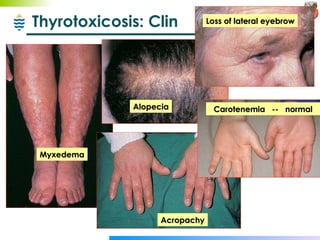 Thyrotoxicosis: Clin Myxedema Alopecia Acropachy Loss of lateral eyebrow Carotenemia  --  normal 