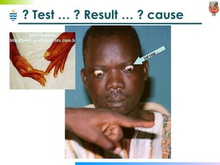 ? Test … ? Result … ? cause Lid Lag… 