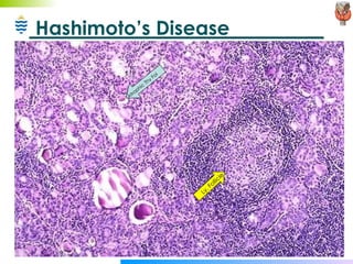 Hashimoto’s Disease Atrophic Thy Fol Ly. Follicle 