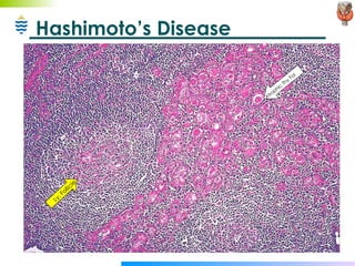Hashimoto’s Disease Atrophic Thy Fol Ly. Follicle 