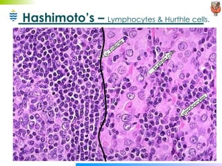Hashimoto’s –  Lymphocytes & Hurthle cells. Lymphocytes Hurthle cells Ly. Follicle 