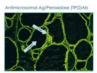 Antimicrosomal Ag/Peroxidase (TPO)Ab -ve Colloid +ve Cells 