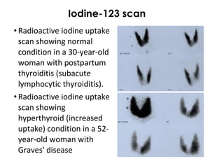 Iodine-123 scan Radioactive iodine uptake scan showing normal condition in a 30-year-old woman with postpartum thyroiditis (subacute lymphocytic thyroiditis). Radioactive iodine uptake scan showing hyperthyroid (increased uptake) condition in a 52-year-old woman with Graves' disease 