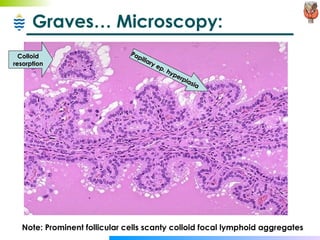 Graves… Microscopy: Note: Prominent follicular cells scanty colloid focal lymphoid aggregates Colloid  resorption Papillary ep. hyperplasia 