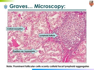 Graves… Microscopy: Note: Prominent follicular cells scanty colloid focal lymphoid aggregates Lymphoid Follicle Colloid resorption Papillary ep. hyperplasia 