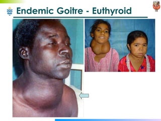 Endemic Goitre - Euthyroid 
