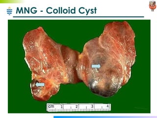 MNG - Colloid Cyst 
