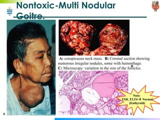 Nontoxic-Multi Nodular Goitre. A:  conspicuous neck mass.  B:  Coronal section showing numerous irregular nodules, some with hemorrhage.  C:  Microscopy: variation in the size of the follicles. Note:  TSH, T3,T4    Normal (Euthyroid) 