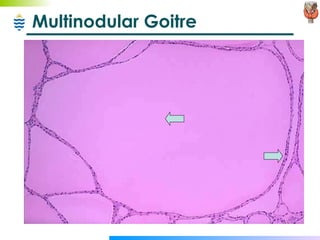Multinodular Goitre 