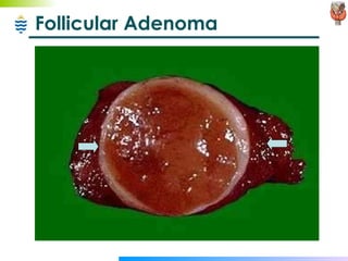 Follicular Adenoma 