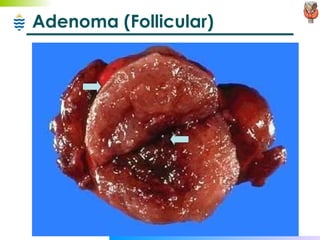 Adenoma (Follicular) 