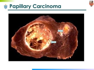 Papillary Carcinoma 