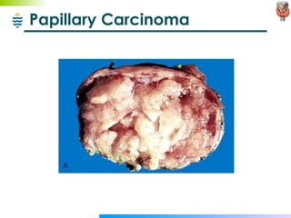 Papillary Carcinoma 